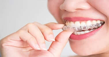Differences and similarities between braces and Invisalign