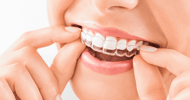 The benefits of Invisalign